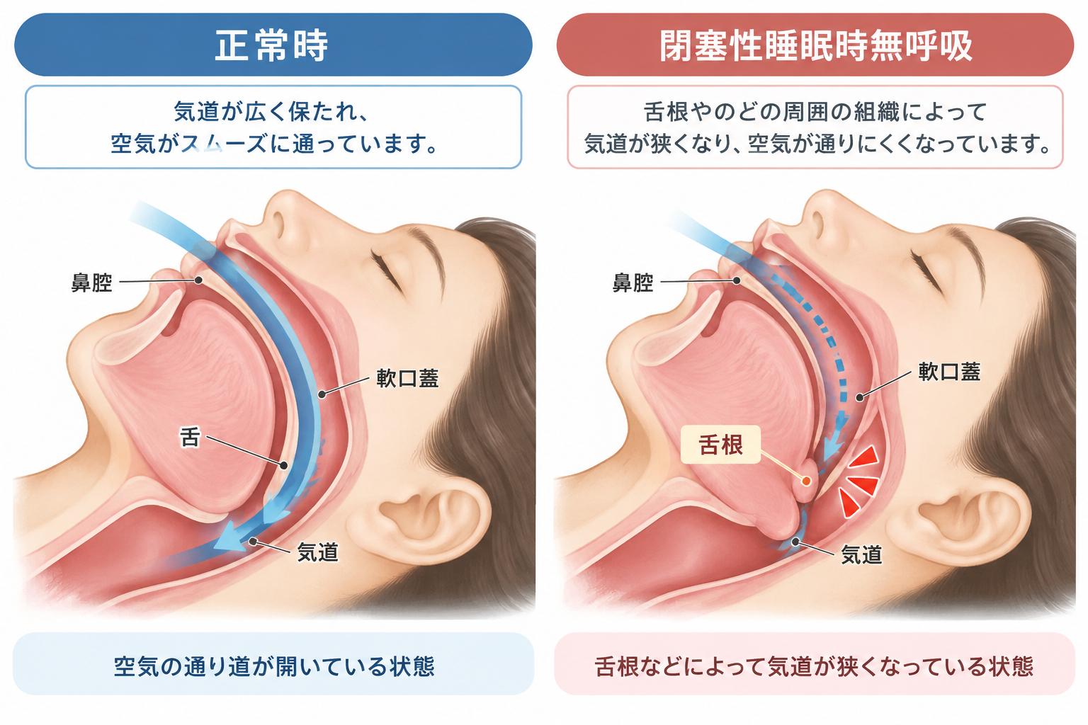 正常時と閉塞性睡眠時無呼吸の気道の違い