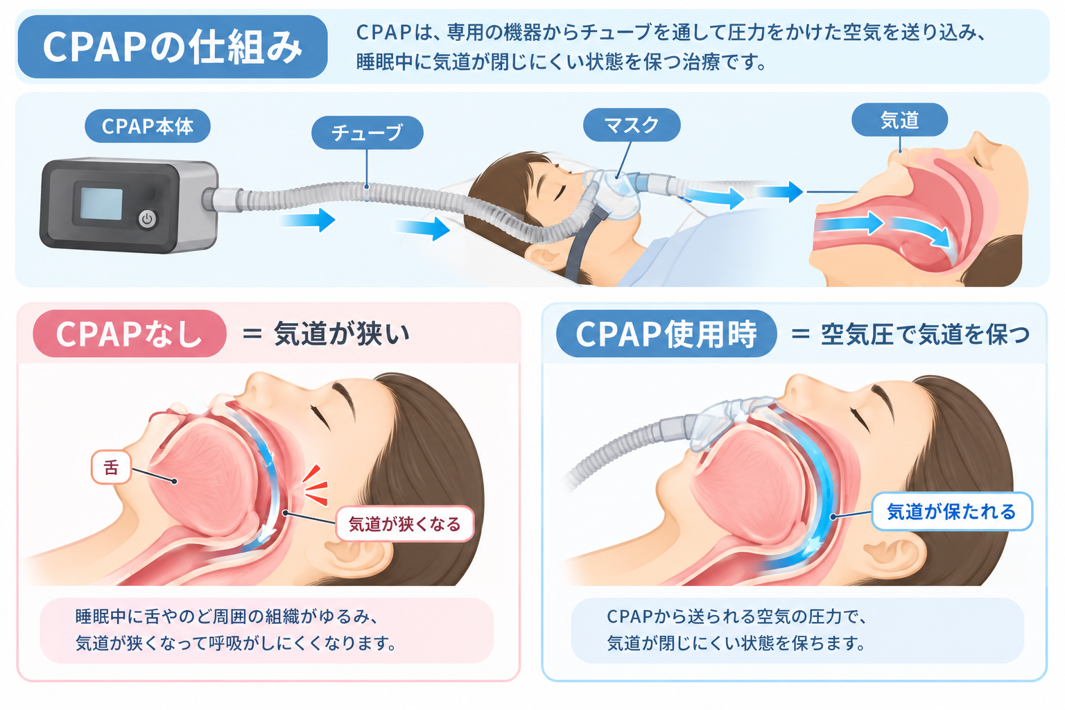CPAP(シーパップ)治療の仕組み